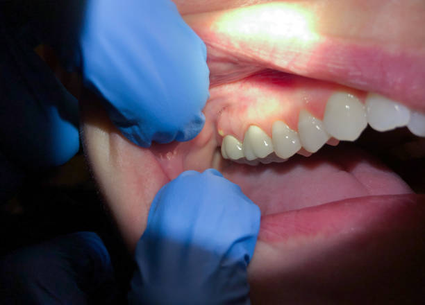 Best Broken or Chipped Tooth Repair in Lynwood, CA